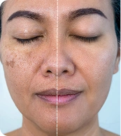 Melasma Treatment