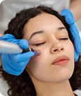microneedling