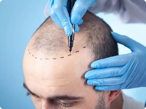 Hair Transplant Course
